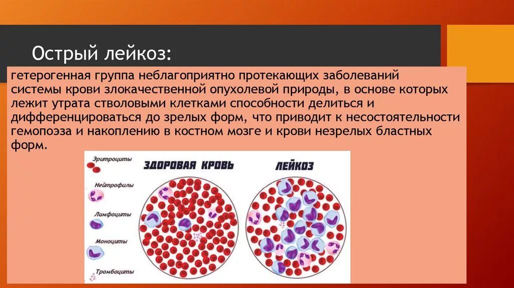 Злокачественные заболевания крови. Острый миелоидный лейкоз картина крови. Острый лейкоз классификация картина крови. Хронический лейкоз морфология крови. Острый лейкоз периферическая кровь.