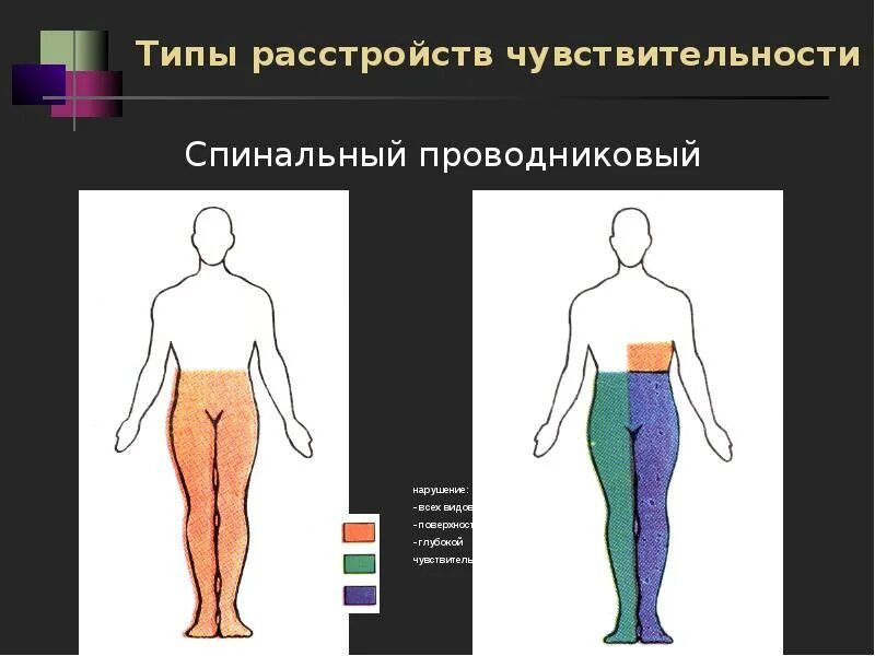 Сегментарный диссоциированный тип нарушения чувствительности. Сегментарный тип расстройства чувствительности. сегментарный тип нарушения чувствительности неврология. типы чувствительных нарушений. периферический тип нарушения чувствительности.