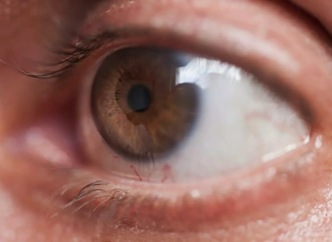 Заболеваниями заболеваний глаз появиться. Глазная болезнь глаукома. Глаукома начальная стадия. Глазная глаукома симптомы. Глаукома внутриглазное.