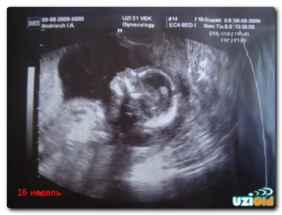 15 акушерских недель. Плод на 16 неделе беременности УЗИ. Плод 16 недель беременности УЗИ плода. УЗИ ребенка на 16 неделе беременности. Фото УЗИ беременности 16-17 недель.