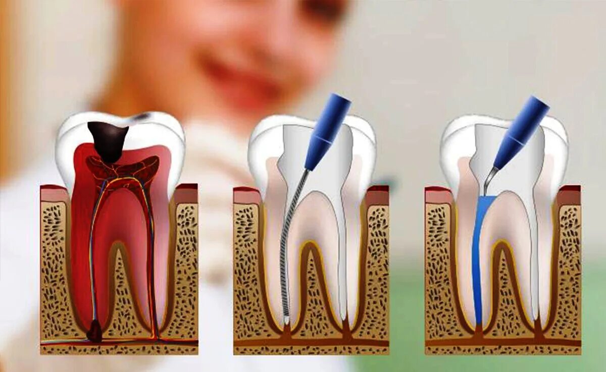 Root canal. 4 Канальный пульпит зуба. Пульпит - воспаление пульпы зуба.