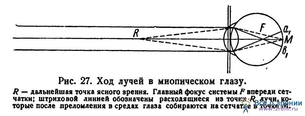 Ход лучей глаза человека. Ход лучей в близоруком глазу. Ход лучей в миопическом глазу схематично. Близорукость схема хода лучей. Близорукость ход лучей в глазе.