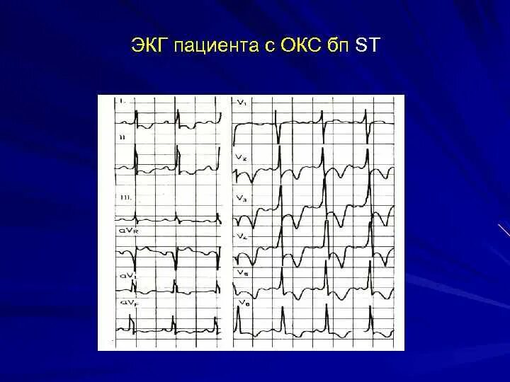 Без подъема st на экг. Окс без подъема St на ЭКГ. ОКСБПST ЭКГ. Окс с подъёмом St ЭКГ. ЭКГ У пациентов с острым коронарным синдромом.