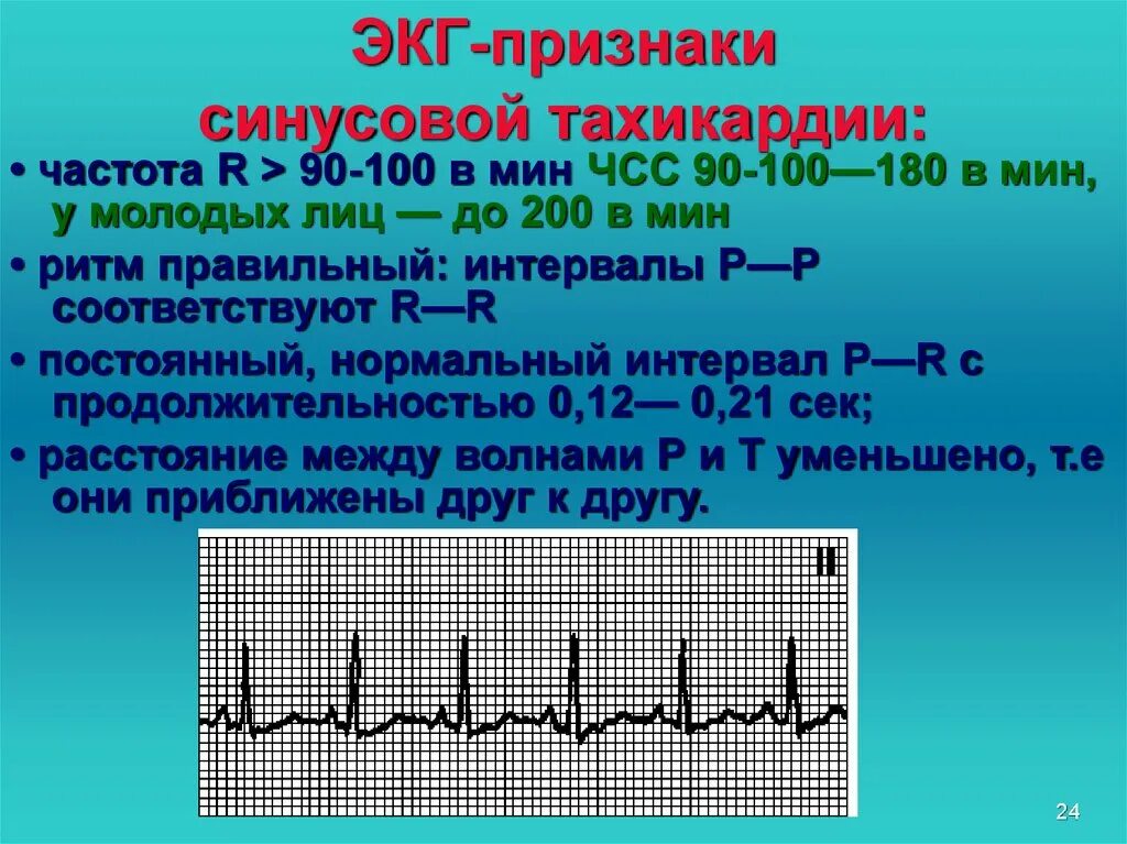Сильное сердцебиение при нагрузках. ЭКГ критерии синусовой тахикардии. Синусовая тахикардия ЭКГ признаки. Синусовая тахикардия ЭКГ расшифровка. ЭКГ тахикардия синусовый ритм ЧСС 90.