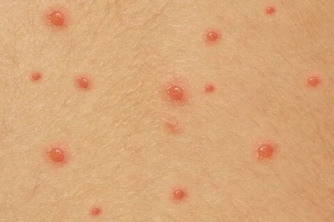 Small red spots, filled with fluid, on white skin. 