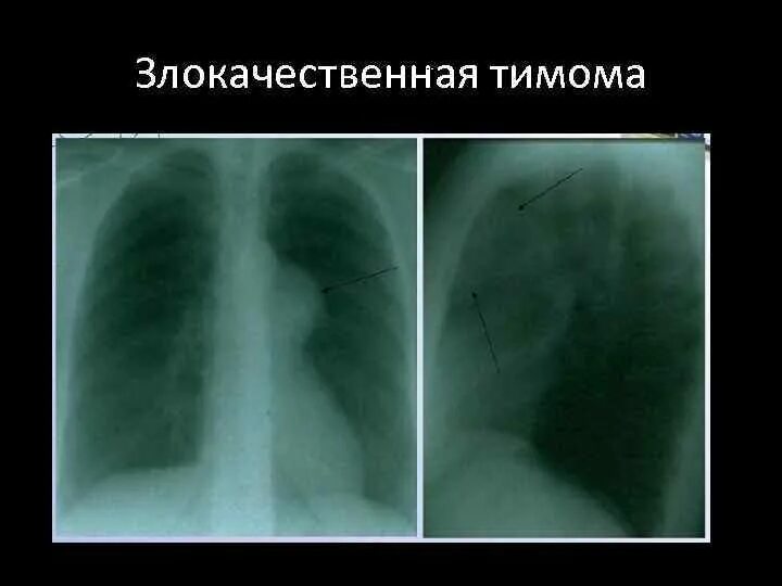 Метастазы в средостении легких