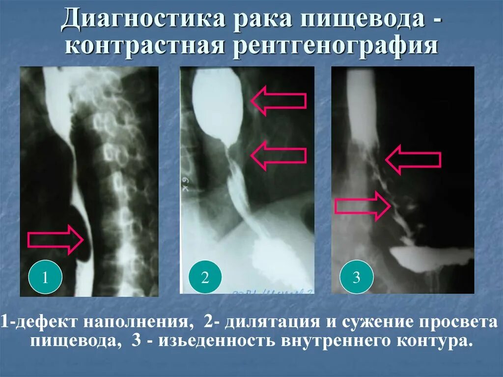 Лучевая пищевода. Опухоль пищевода рентген. Стриктура пищевода рентген симптомы. Рубцовое сужение пищевода рентген.