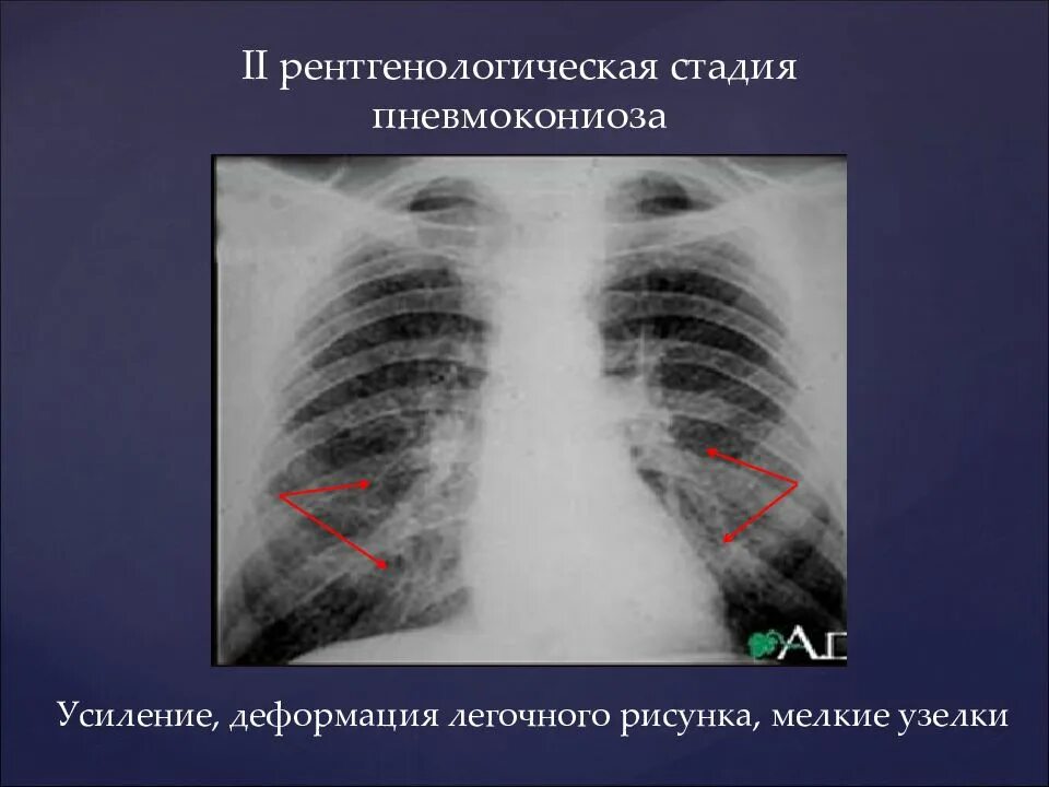 Легочной рисунок диффузно деформирован