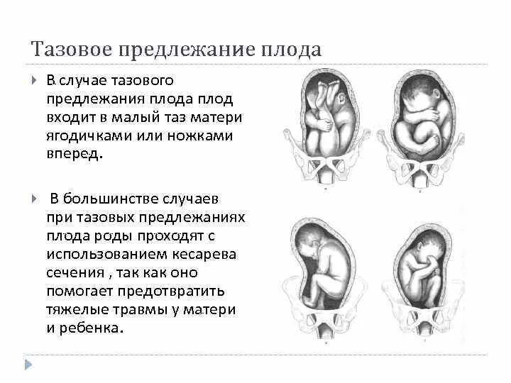 Тазовое предлежание матки. Продольное головное предлежание плода. положение продольное предлежание тазовое смешанное. положение плода продольное предлежание головное. таза предлежания плода.