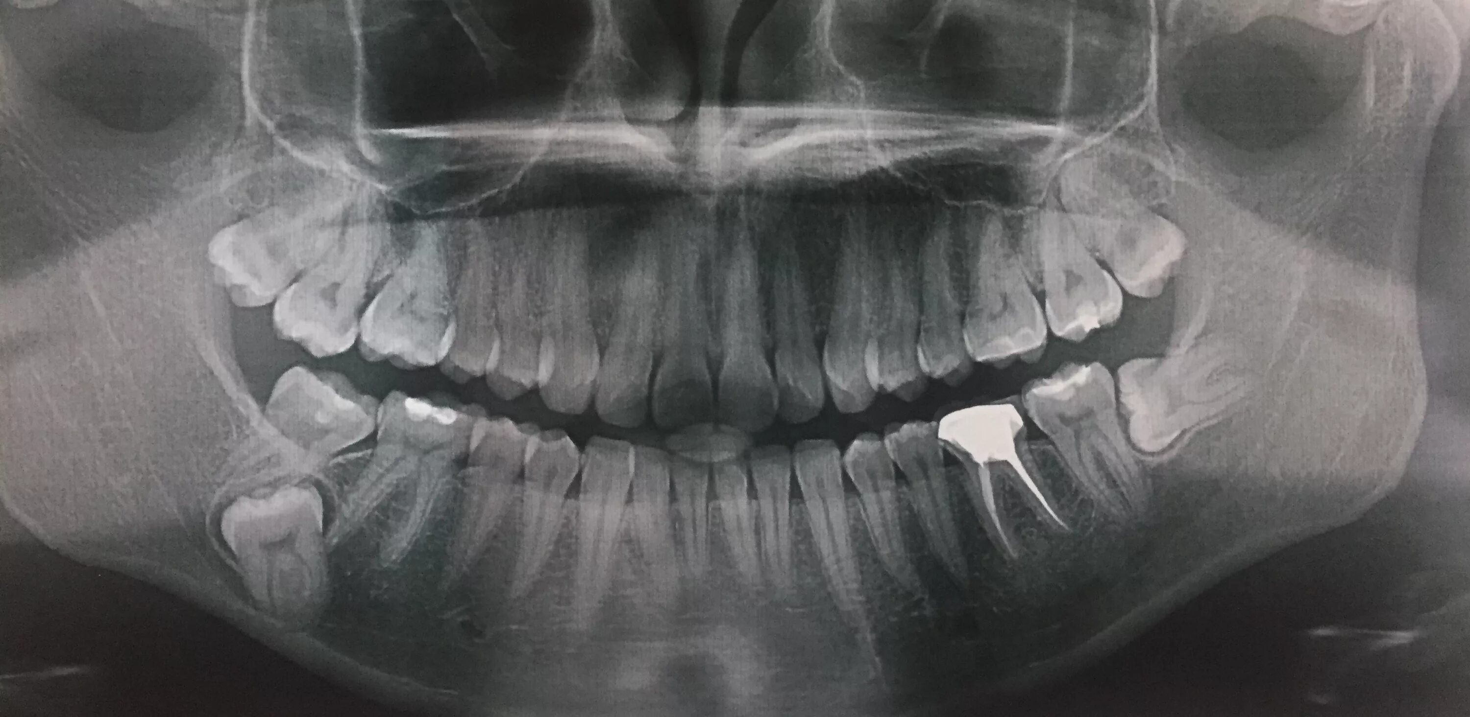 Зуб 8 нижний. Ретинированный зуб мудрости рентген. Ретинированный зуб мудрости ОПТГ. Ретинированный 8 зуб рентген.
