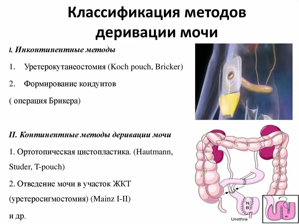 Илеокондуита по Брикеру. Деривация мочи по Брикеру. Цистоэктомия