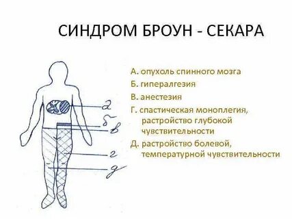 Синдром броун