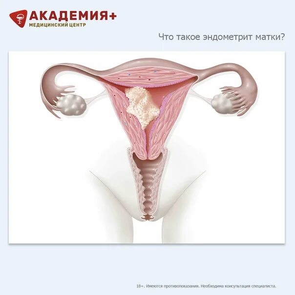 Что такое эндометрия матки