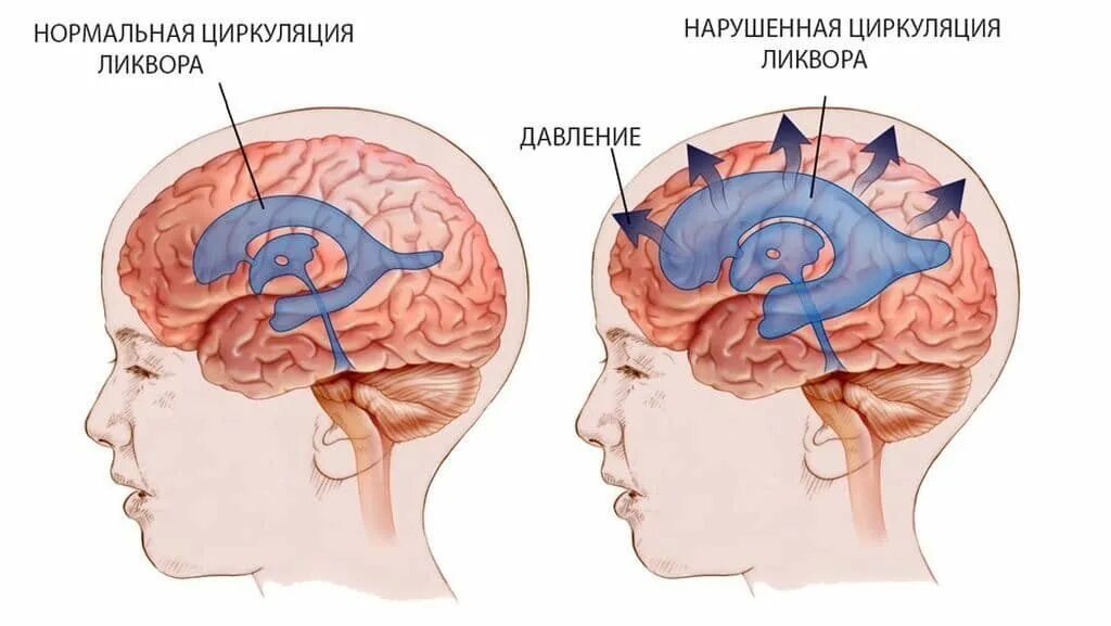 Желудочки головного мозга при гидроцефалии. Гиперсекреторная гидроцефалия. Гипертензионно-гидроцефальный синдром у новорожденных симптомы. Церебральная ишемия у новорожденного 2 степени.