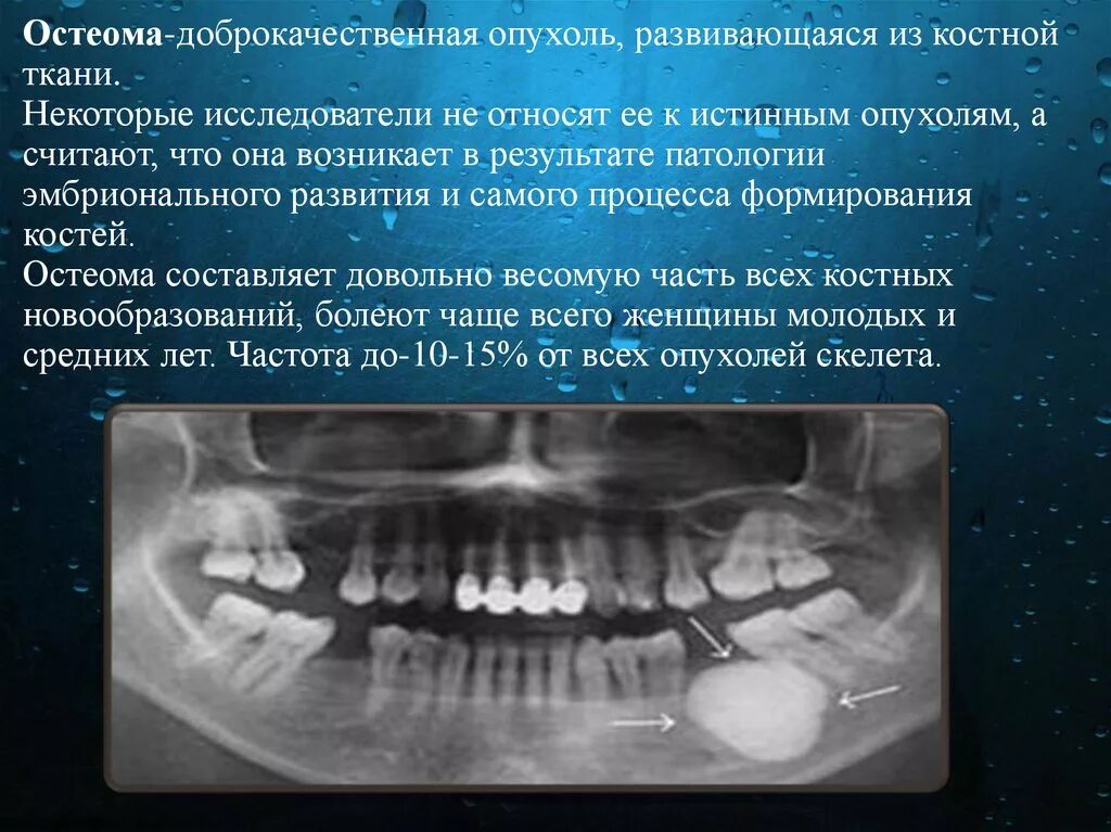 Доброкачественные новообразования костей остеоид остеома. Доброкачественные новообразования костей. Опухоли костей презентация. Опухоли костей презентация. Доброкачественная костная опухоль.