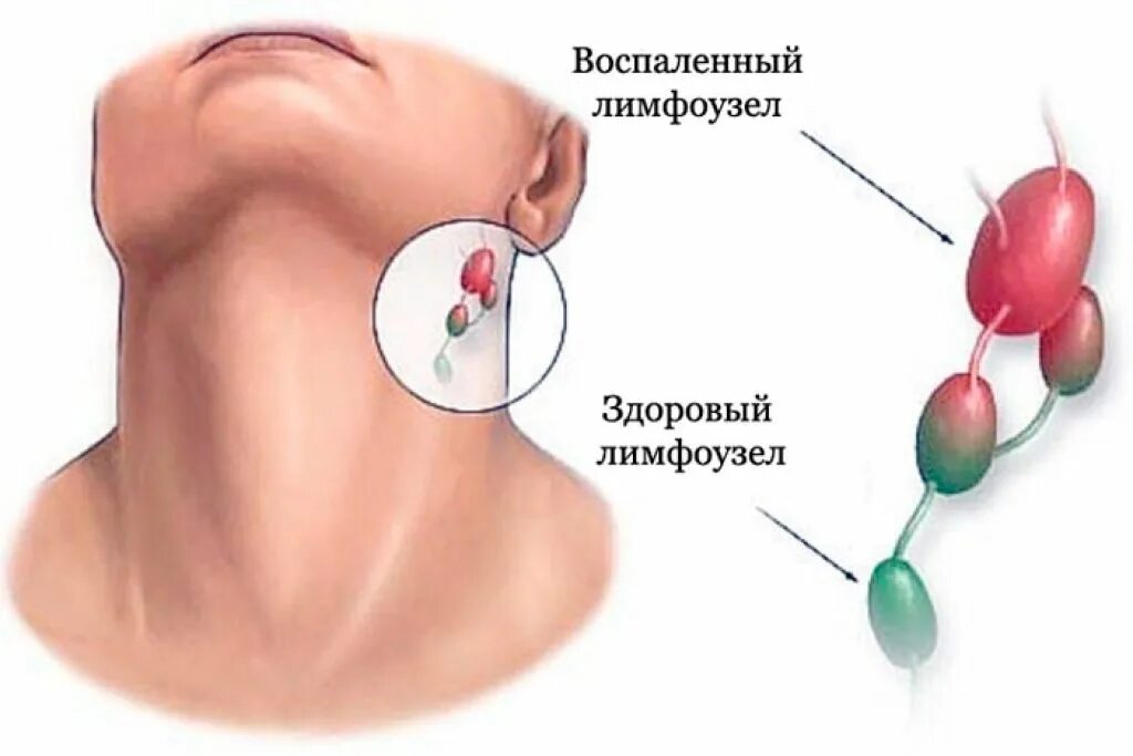 Можно ли вылечить лимфоузел