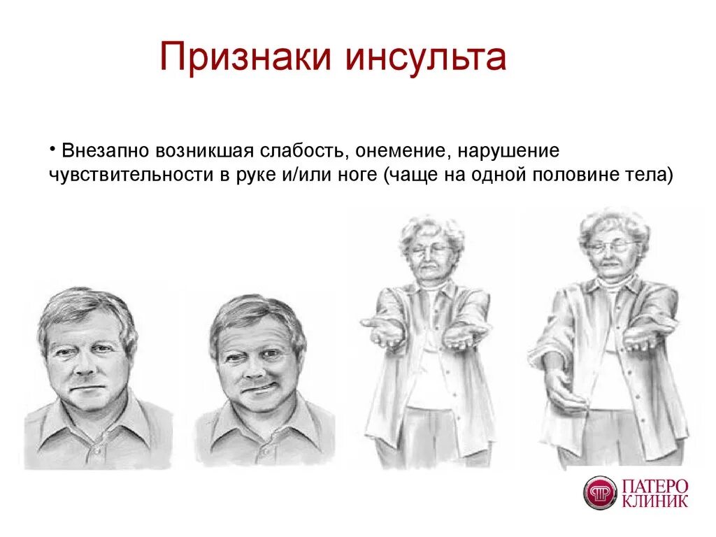 Инсульт симптомы. Признаки инсульта. Предвестники инсульта. Инсульт симптомы первые признаки.