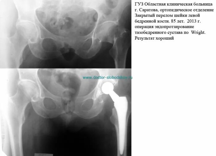 К какому врачу обращаться с тазобедренным суставом. Перелом тазобедренного сустава в 70 лет. Разрыв вертлужной губы тазобедренного сустава симптомы. Рентген тазобедренного сустава перелом большого вертела. Шейки левой бедренной кости.