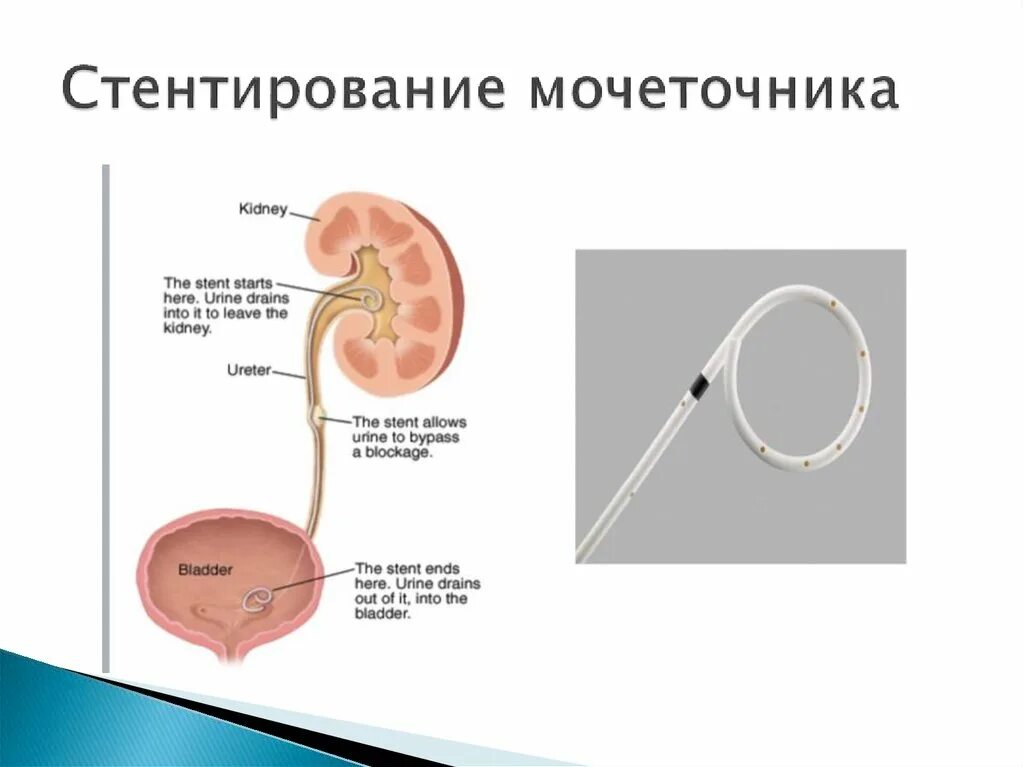 Стенд в почке что это. Стенд в почке что это