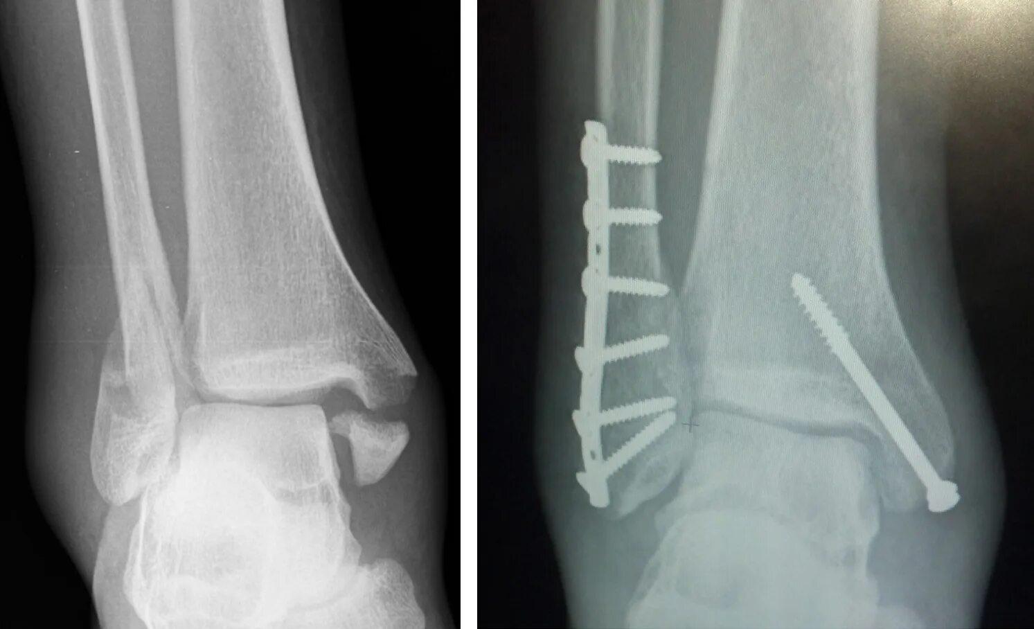 Перелом наружной лодыжки левой голени с подвывихом. Пронационный подвывих лодыжки. Подвывих стопы кнаружи рентген. Подвывих кнаружи. Перелом латеральной лодыжки рентген.