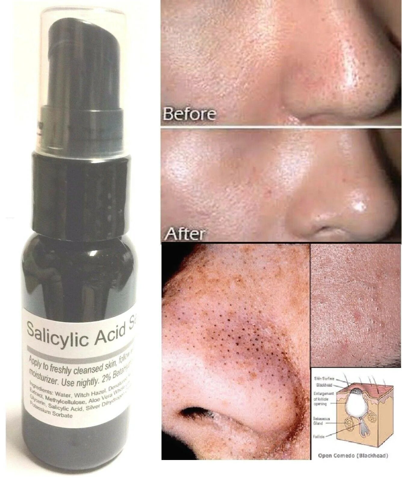 для растворения закрытых комедонов. ходи лэнд с ретинолом лосьон. мазь с ретинолом для лица. средство от закрытых комедонов. дифферин от закрытых комедонов.