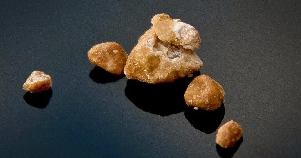 Какие ощущения когда выходят камни. Уратные камни в мочеточнике. Какие ощущения когда выходят камни. Какие ощущения когда выходят камни. Почечные камни цистиновые.