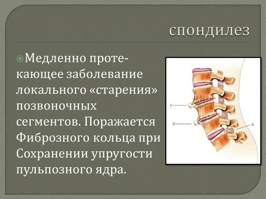 Спондилеза спондилоартроза поясничного отдела позвоночника. Спондилез и спондилоартроз. Заболевание позвоночника спондилез. Остеохондроз спондилез спондилоартроз. Полисегментарный спондилез.