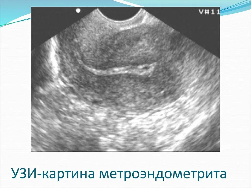 Патология эндометрия матки: найдено 89 изображений