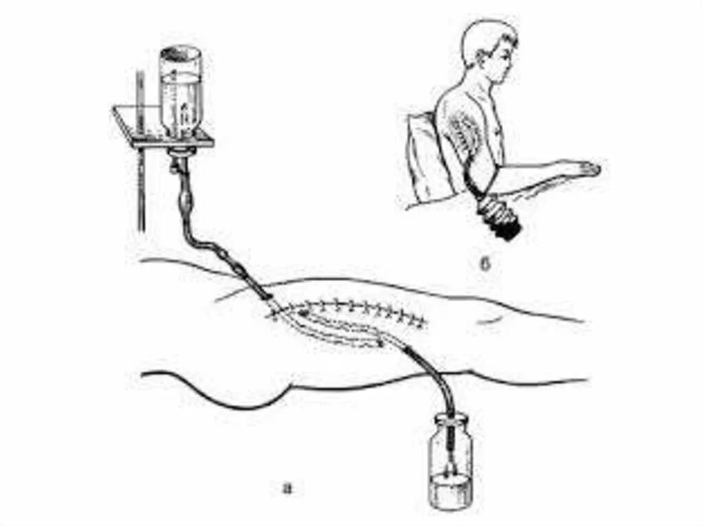 Схема проточно-промывной системы для диализа раны. Физическая антисептика дренирование раны. Проточно промывная система для диализа раны схема. Проточно промывное дренирование в хирургии.