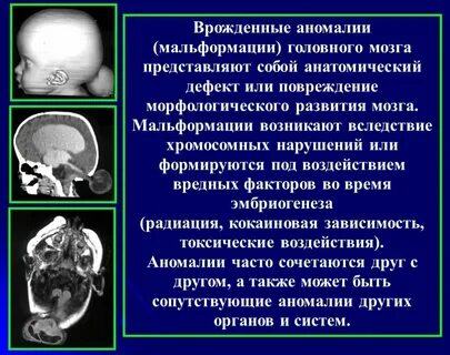 Врожденный порок мозга