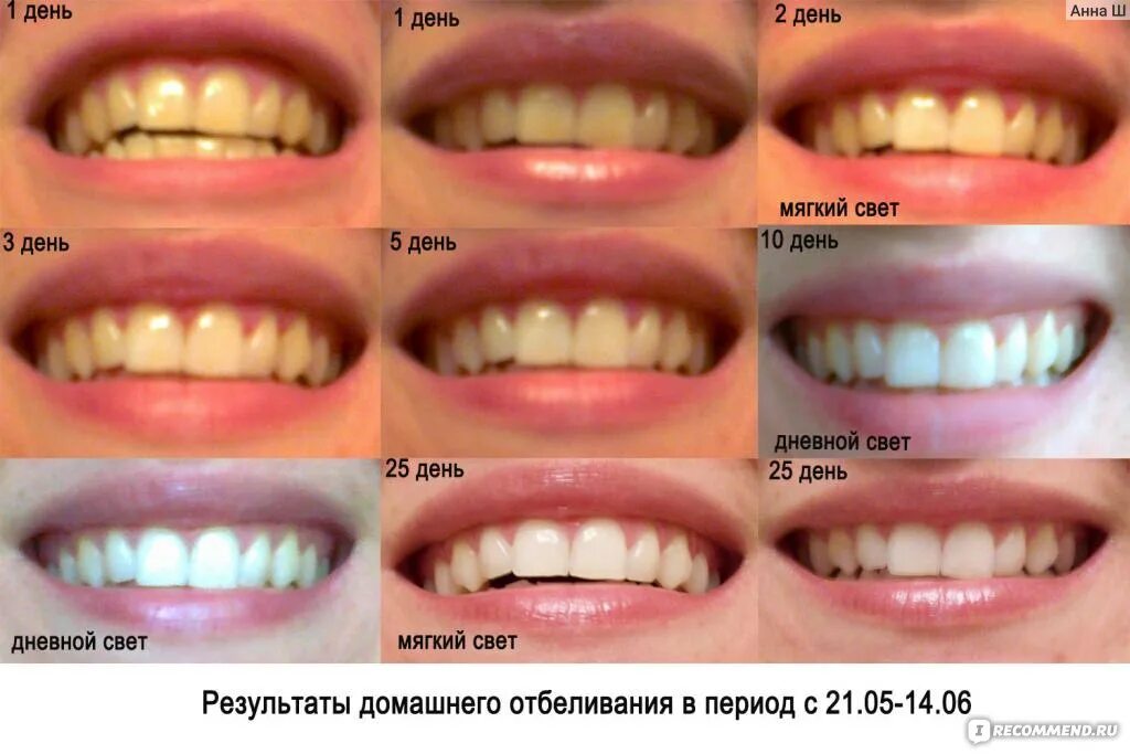 Отбеливание зубов. Отбеливание зубов перекисью. Отбеливание зубов до и после. Отбеливание зубов отзывы цены