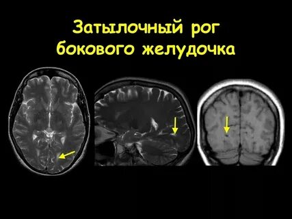 Задние рога у детей