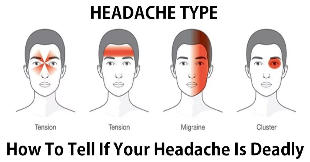 Сильная боль в лобной части. Типы головной боли. Типы головной боли по зонам. Головная боль схема. Распределение головных болей.