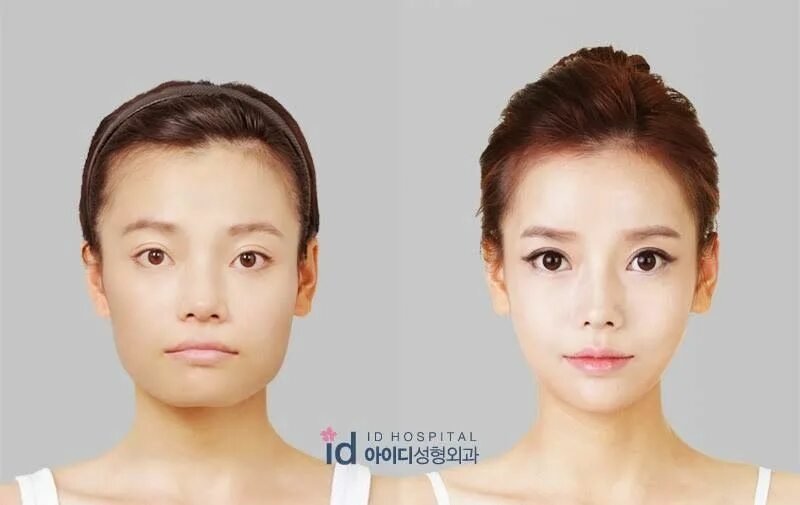 cosmetic surgery korea review facial contouring surgery, amazing makeo... Plasti