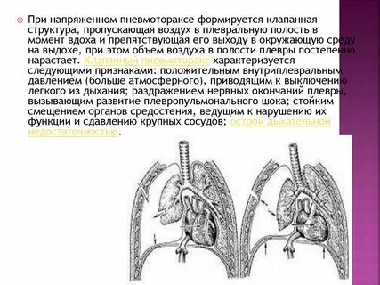Пневмоторакс плевральной полости