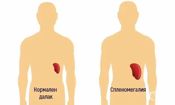 Далак препарат. Умеренная спленомегалия у взрослого что это