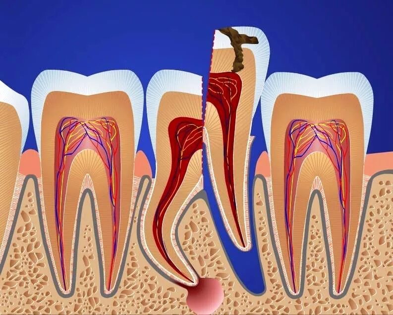 Сложное удаление зуба. Гемисекция корня зуба этапы. Гемисекция и ампутация корня зуба. Гемисекция корня зуба операция.