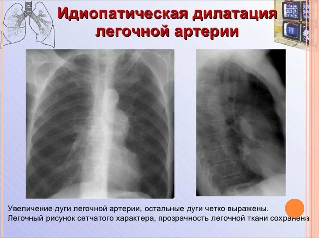 Диагноз фиброз легких. Идиопатический легочный фиброз рентген. идиопатический фиброзирующий альвеолит кт. фиброзирующий альвеолит рентген. заболевания средостения презентация.