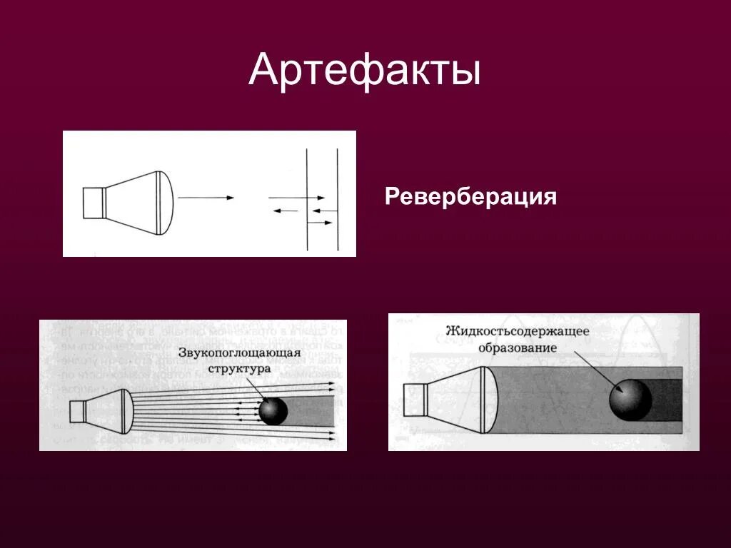 Ультразвуковые артефакты. Артефакт реверберации. Артефакты УЗИ. Артефакты в ультразвуке. Эффект реверберации