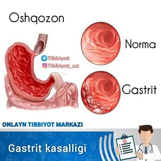 Гастрит 2024