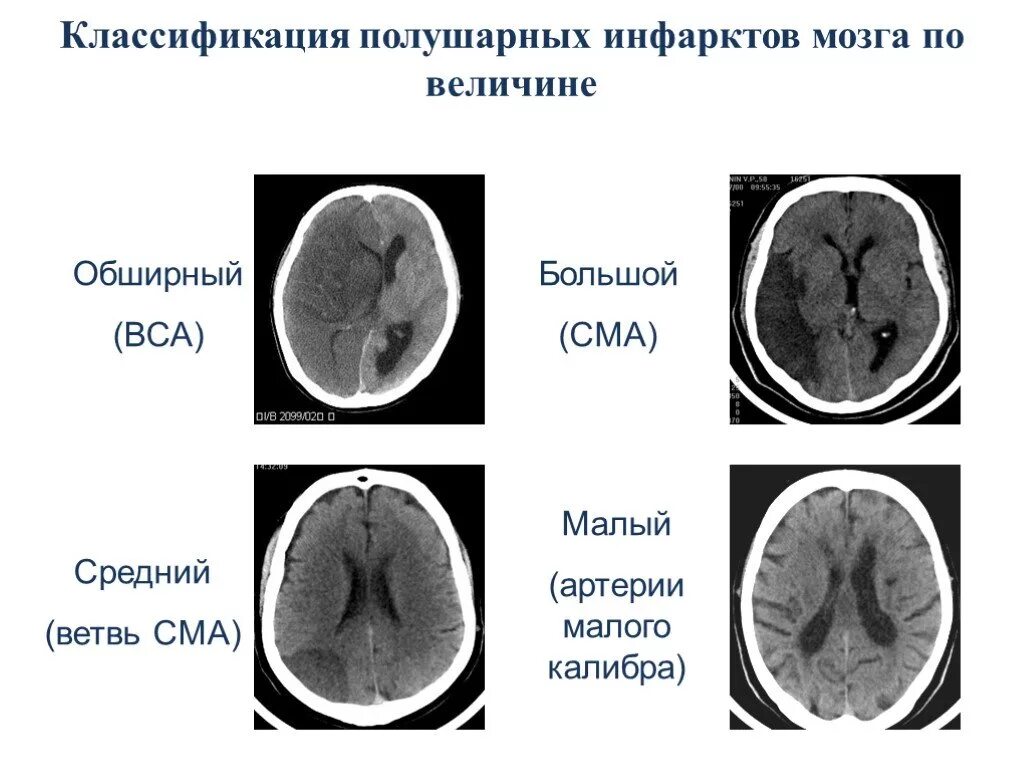 Инфаркт средней мозговой артерии. Инфаркты в бассейне кровоснабжения средней мозговой артерии. Инфаркт головного мозга классификация. Ишемический инсульт в бассейне правой СМА.