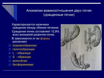 Аномалии почек и мочеточников