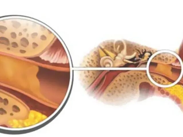Почему возникает пробка в ухе