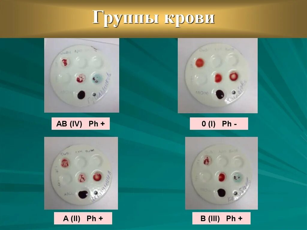 Проба на совместимость крови. Определение группы крови на совместимость. Группа крови. Проба на индивидуальную совместимость при переливании крови.