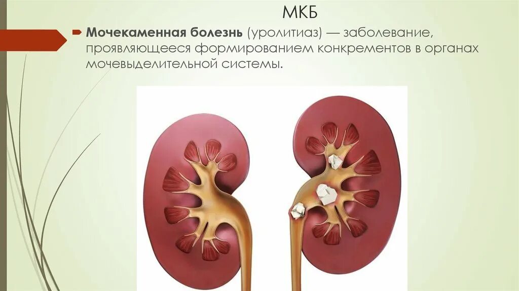 Мочекаменная болезнь мочеточника. Заболевания мочевыделительной системы мочекаменная болезнь. Расположение камней в почках. Мочекаменная болезнь схема.