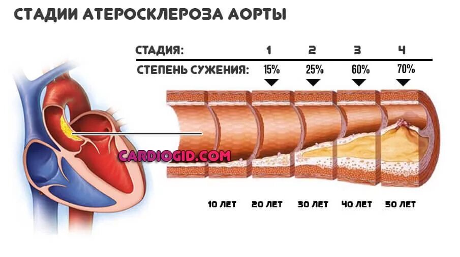 2 стадия атеросклероза