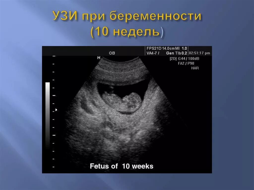 УЗИ беременной 10 недель. УЗИ на 10 акушерской неделе беременности. Почему на 10 неделе беременности