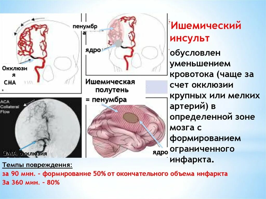 Зона инсульта. Ишемической полутени (Пенумбры). Ишемическая полутень Пенумбра. Ишемический инсульт обусловлен.