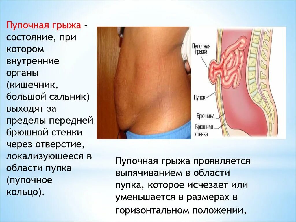 Брюшная грыжа симптомы и лечение. Грыжа живота классификация.