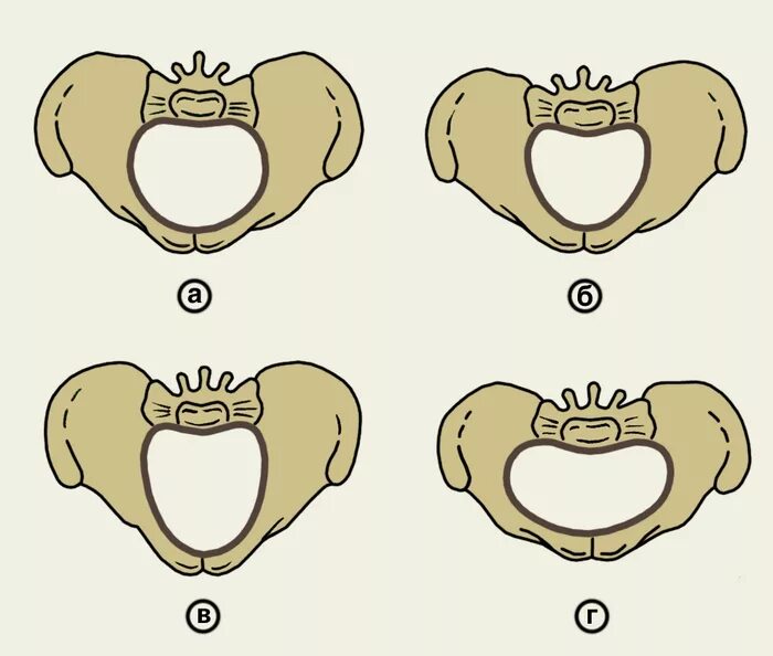 Кесарево узкий таз. Многообразная акушерская патология узкий таз. Формы сужения таза Акушерство. Анатомически узкий таз в акушерстве классификация. Анатомический узкий таз в акушерстве.